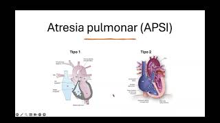 Atresia pulmonar [upl. by Karia]