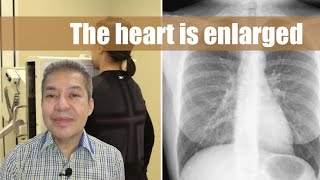 The heart is enlarged sa chest Xray [upl. by Yhprum]