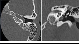 Aberrant internal carotid artery [upl. by Moina]