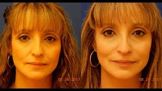 Expert Dermal Filler Injection  Nasolabial Folds NLF  Juvederm Vollure XC [upl. by Kimberlee]