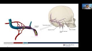 Etiology of Idiopathic Intracranial Hypertension IIH [upl. by Enigroeg325]