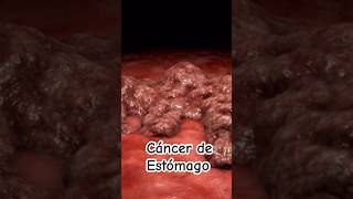 ¡Alerta Signos y síntomas de cáncer de estómago  Dr William Guerrero medicina shorts [upl. by Jacobah954]