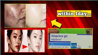 adaferin gel 01 reviews adaferin gel for acne scars [upl. by Eicul]