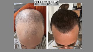 quotMan Bunquot Hair Transplant  Before and After Result  Feller amp Bloxham Medical Long Island NYC NY [upl. by Siurad]