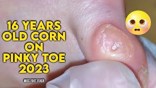 16 YEARS OLD SUPER PAINFUL CORN REMOVAL 2023 BY FOOT SPECIALIST PODIATRIST MISS FOOT FIXER [upl. by Adolpho]