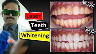 Teeth Whitening With Laser  Fastest amp Safest way [upl. by Wendin]