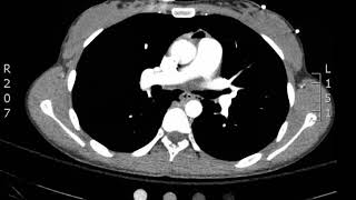 Chest Pneumomediastinum Axial CT JETem 2018 [upl. by Leik]