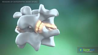 Osteophytes bone spurs Reasons [upl. by Eemaj]