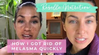 HOW I HEALED MY MELASMADARK SPOTS QUICKLY  REBELLE NUTRITION [upl. by Ivzt]