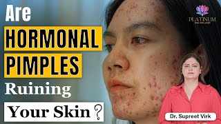 What causes Hormonal acne  How to deal with hormonal acne [upl. by Naxela828]