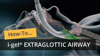 i gel Extraglottic Airway [upl. by Wheeler]