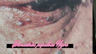 Dermatosis papulosa Nigra skin DPN skincare [upl. by Pavyer]