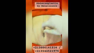 Abdominoplastie by Renaissance [upl. by Nanda283]