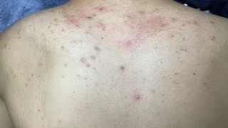 ACNE TREATMENT VU QUYNH MI  Acne On Back FULL [upl. by Locin]