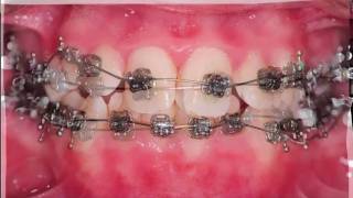 Braces and extractions  wwwokeeffeorthodonticscom [upl. by Archle]