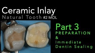 Lithium Disilicate Ceramics Part 3 Preparation and Immediate Dentin Sealing IDS [upl. by Leahplar802]