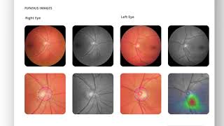 AI powered fundus camera to screen glaucoma  Remidio [upl. by Ynaffad309]