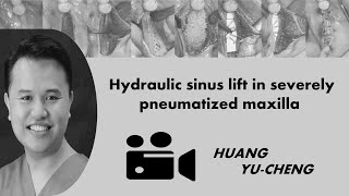 Hydraulic sinus lift in severely pneumatized maxilla [upl. by Saxon105]