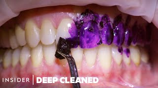 How Teeth Are Professionally Deep Cleaned  Deep Cleaned [upl. by Artenahs]