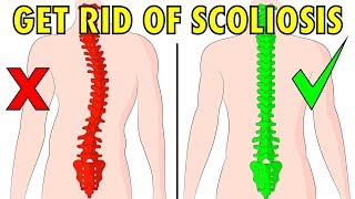 How to fix scoliosis naturally in 4 minutes a day [upl. by Bywoods]