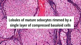 Pathology of Sebaceous Hyperplasia by Dr Sampurna Roy MD [upl. by Stanislaus]