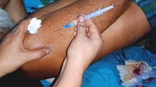 im injection video Dexamethasone im injection push 24 Ep 23 Anik Injection Tips [upl. by Dagnah495]