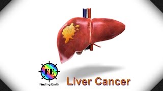 Liver Cancer  Symptom Causes amp Diagnosis Finding Earth [upl. by Aizan]