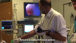 Midgastric functional stenosis after sleeve 30 mm Rigiflex dilatation By Dr Yerdel [upl. by Noryak]