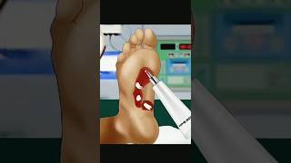 ASMR Foot Sore Treatment Part 2 2D Animation Surgery asmr 2danimation treatment surjery short [upl. by Daegal]