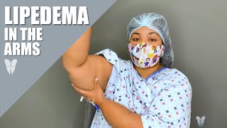 Phases of Lipedema Reduction Surgery  Lymphatic Sparing Arm Lift  Total Lipedema Care [upl. by Ainna143]