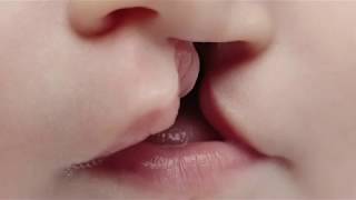 Cleft lip and palate  Akron Childrens Hospital video [upl. by Linetta]