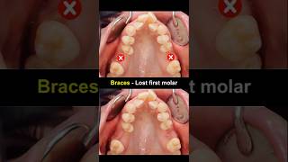 Braces wheb lost first molar teeth braces orthodontist dentist [upl. by Attiuqal]