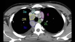 Les ganglions médiastinaux en scanner pour les internes [upl. by Marena604]