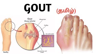 Gout  Causes  Symptoms  Risk factors  Treatment  தமிழ் [upl. by Dinny193]