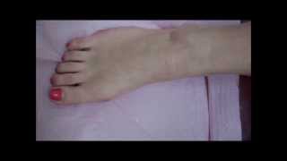 Bunion Treatment by Dr Kevin Lam of Naples Florida [upl. by Eedyah]