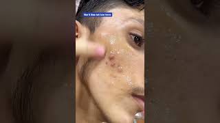 Glow amp Clean Anti Acne Serum ameenbeautytips youtubeshorts [upl. by Namor]