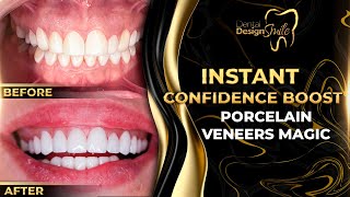 Instant Confidence Boost Porcelain Veneers Magic [upl. by Creighton78]