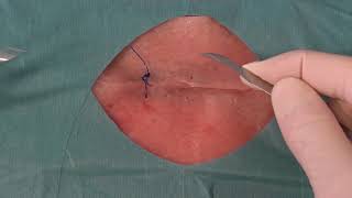 Fjerning av sutur  Suture removal [upl. by Rosalyn752]