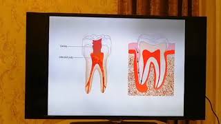 Pulp Disease  what Should I Know Diagnosis Treatment [upl. by Eelymmij704]