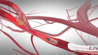 TCAR Transcarotid Arterial Revascularization [upl. by Aicenod414]