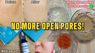 How to get Rid of Large Open Pores Best Home Remedies  Abial openpores [upl. by Sherrer85]