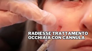 Radiesse Trattamento Occhiaia con Cannula Dr F Bernardini [upl. by Lecram]