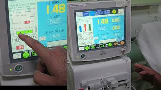 Dialysate sodium adjustment in nipro machine dialysis rounds VIDEO 184 [upl. by Aynekat714]