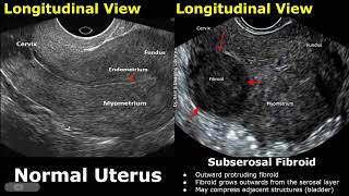 Uterus Ultrasound Normal Vs Subserosal Fibroid Images  Uterine Leiomyomas Cases  Pelvic USG Cases [upl. by Ylrebme]