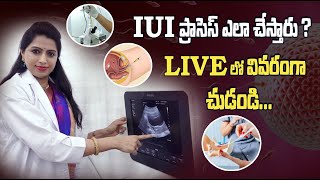 IVF Expert Dr Jyothi Clearly Explains IUI Process Step By Step In LIVE  Ferty9 [upl. by Refotsirk]