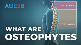 What Are Osteophytes  Spinal Bone Spurs  Anatomy  Degenerative Disc Disease [upl. by Amena]