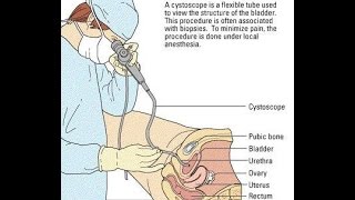 Video Cystoscopy Actual Procedure ENG SUB [upl. by Eradis584]