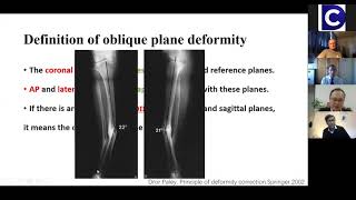 WEBINAR 6  OBLIQUE PLANE DEFORMITY [upl. by Artekal43]