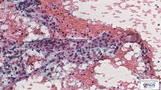 Thyroid cytology Lymphocytic thyroiditis [upl. by Sidoeht266]