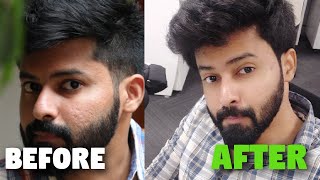 Minimise Large Pores  Acne Scars Control  முகத்தில் உள்ள பள்ளம் நீங்க இதைத்தான் செய்யனும் [upl. by Varion787]